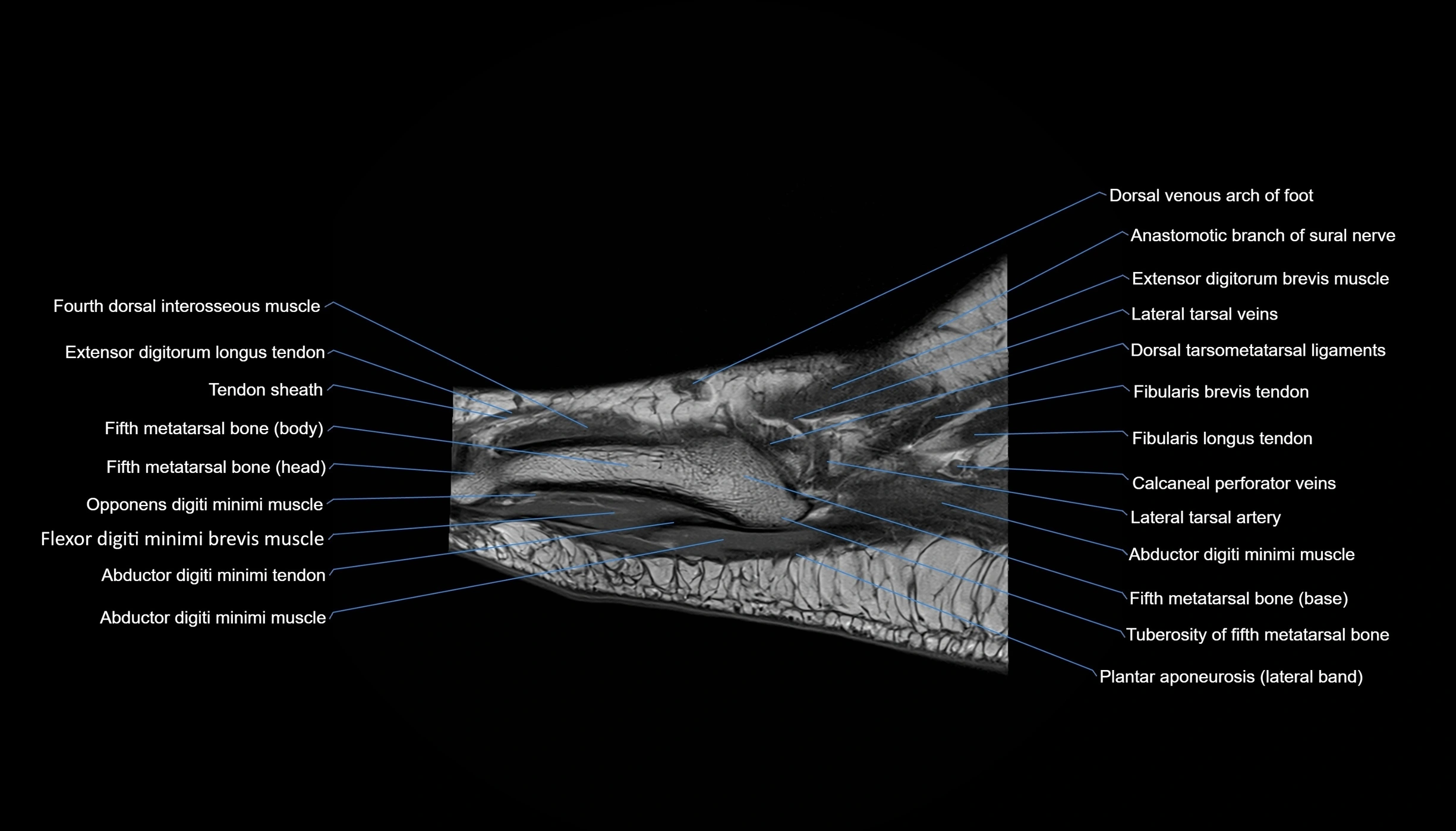 MRI mid foot sagittal cross sectional anatomy 3T  radiology  image-img-00001-00007.webp